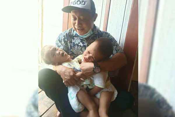 Bayi kembar siam