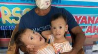 bayi kembar siam