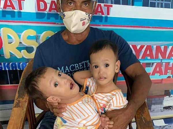 bayi kembar siam