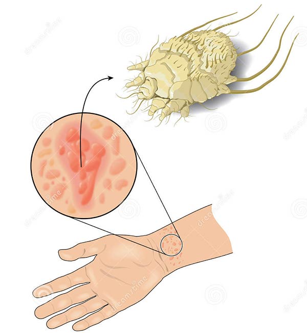 scabies