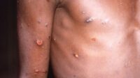 monkeypox