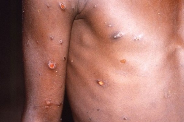 monkeypox