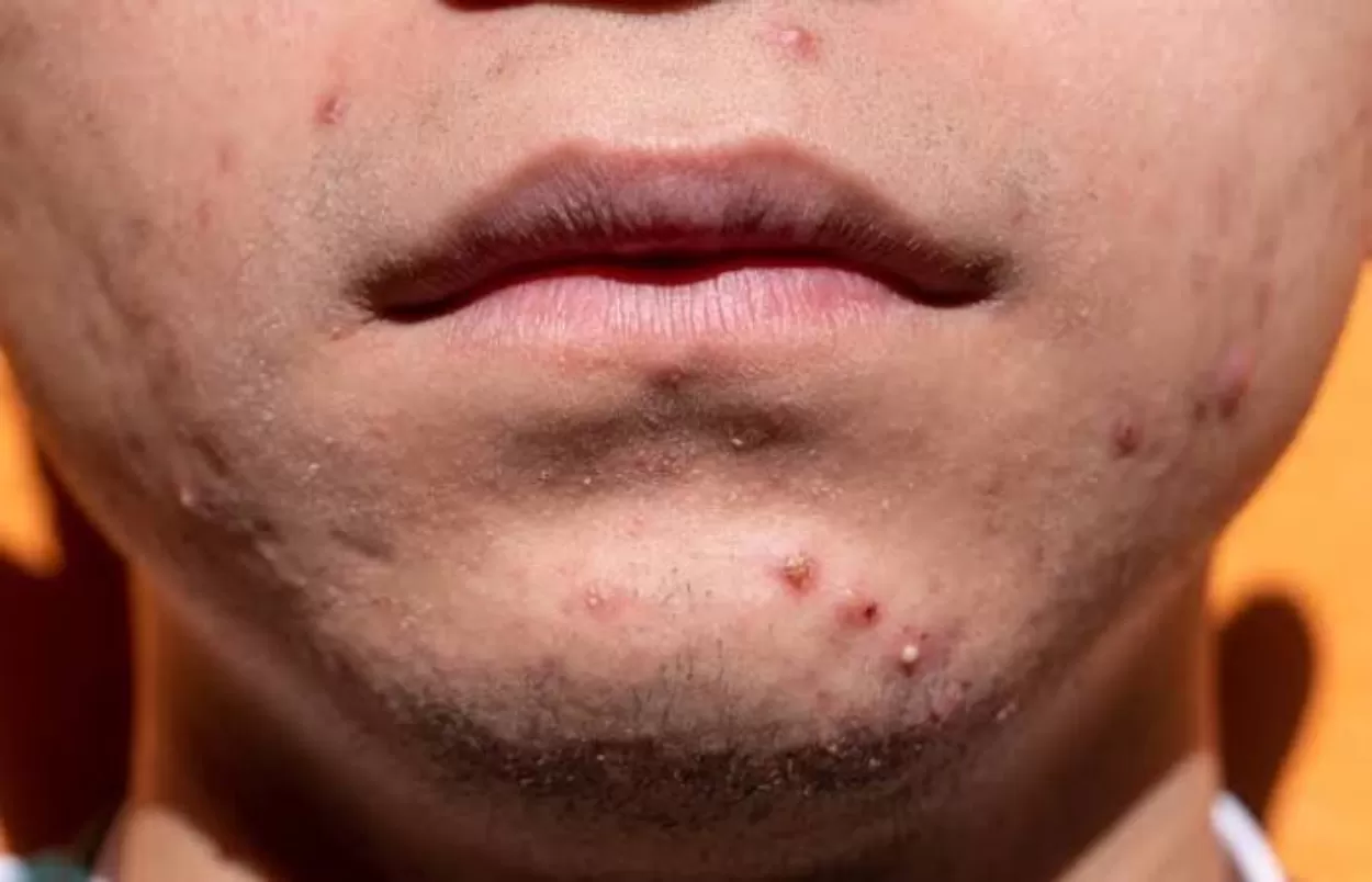 cara menghilangkan jerawat cara menghilangkan jerawat